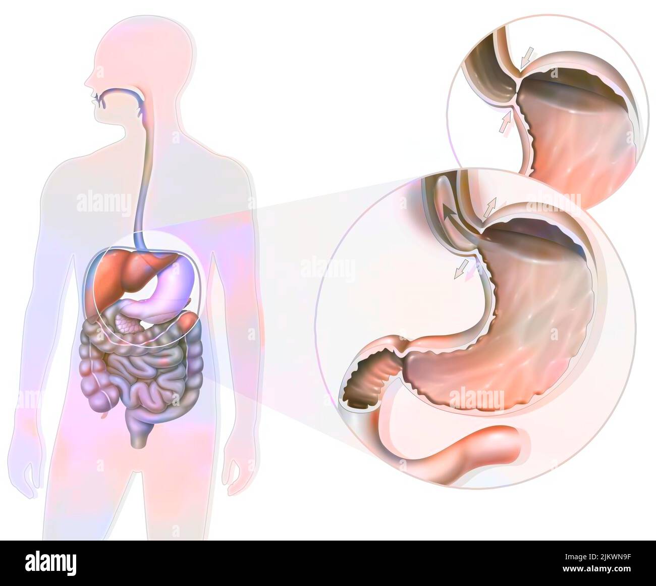 Gastroösophageale Refluxkrankheit: Lokalisation des Magens und Zoom des gastroösophagealen Schließmuskel. Stockfoto