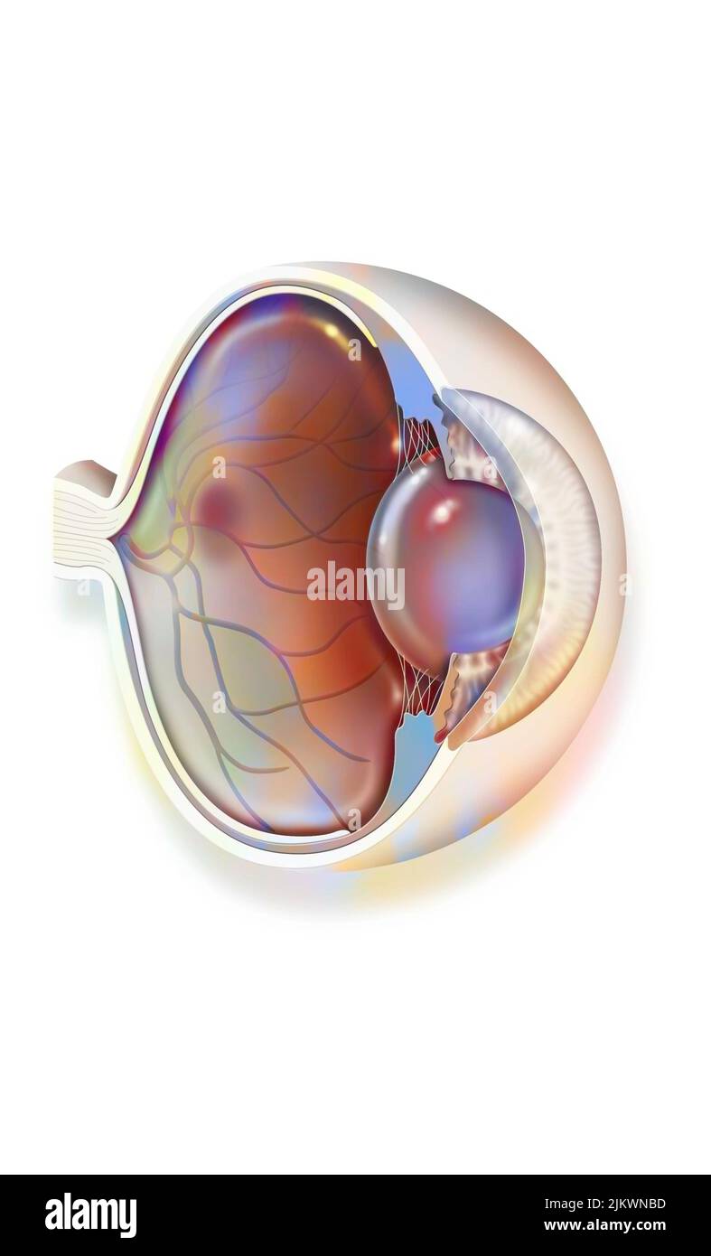 Cutaway Eye: Makuladegeneration (opaker roter Fleck auf der Makula). Stockfoto