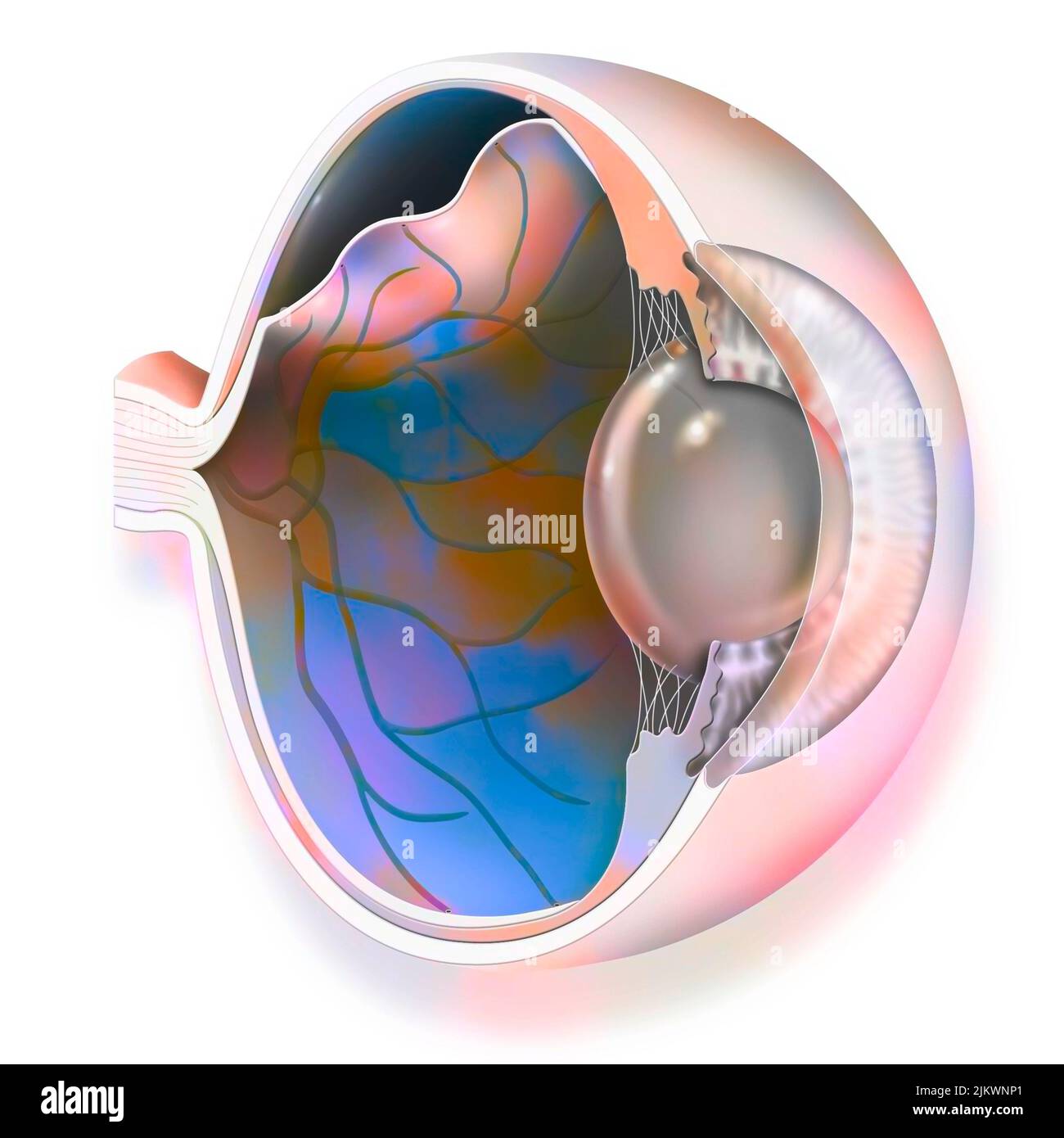 Auge: Ablösung der Netzhaut, die sich von der darunter liegenden Aderhaut löst. Stockfoto