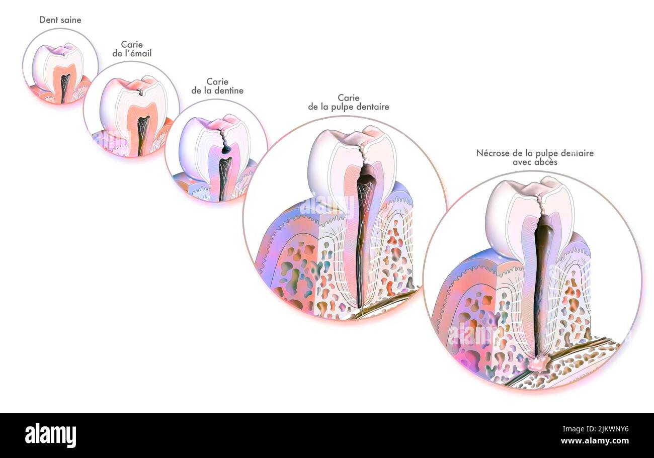 Zahn: Bildung und Entwicklung von Zahnkaries. Stockfoto