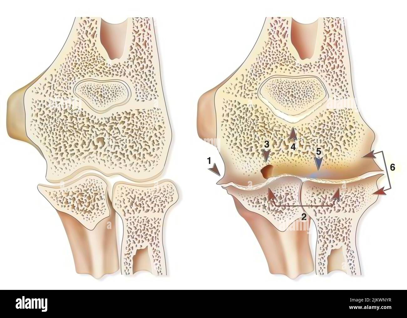 Vergleich zwischen einem gesunden Ellenbogen und einer hämophilen Arthropathie (Hämarthrose). Stockfoto