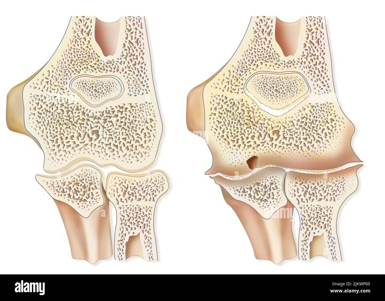 Vergleich zwischen einem gesunden Ellenbogen und einer hämophilen Arthropathie (Hämarthrose). Stockfoto