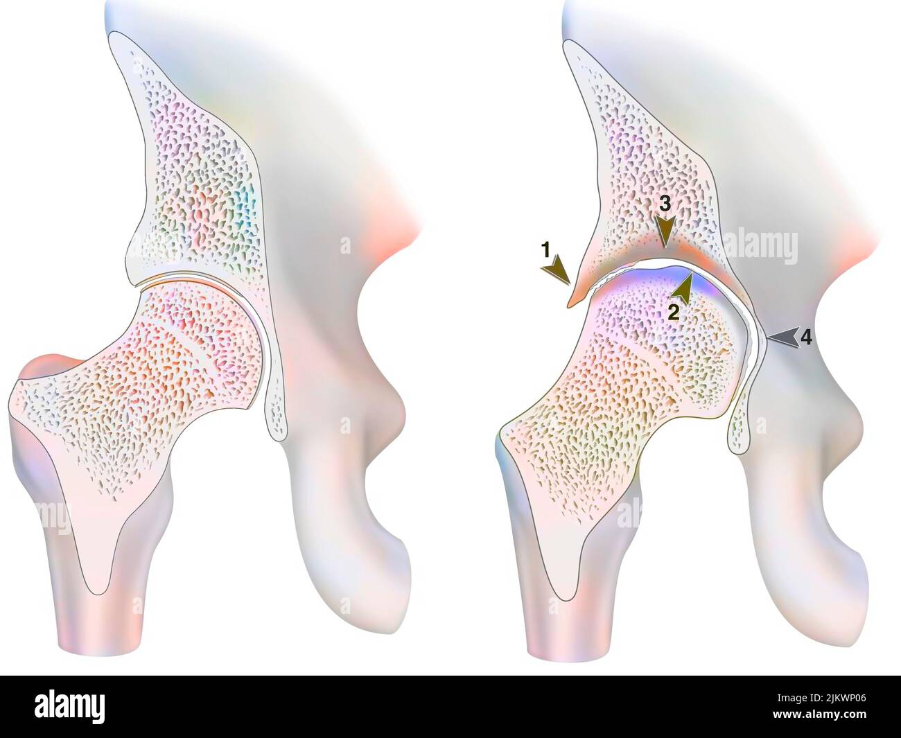 Gesunder Knöchel und Knöchel mit hämophiler Arthropathie im Frontalschnitt. Stockfoto