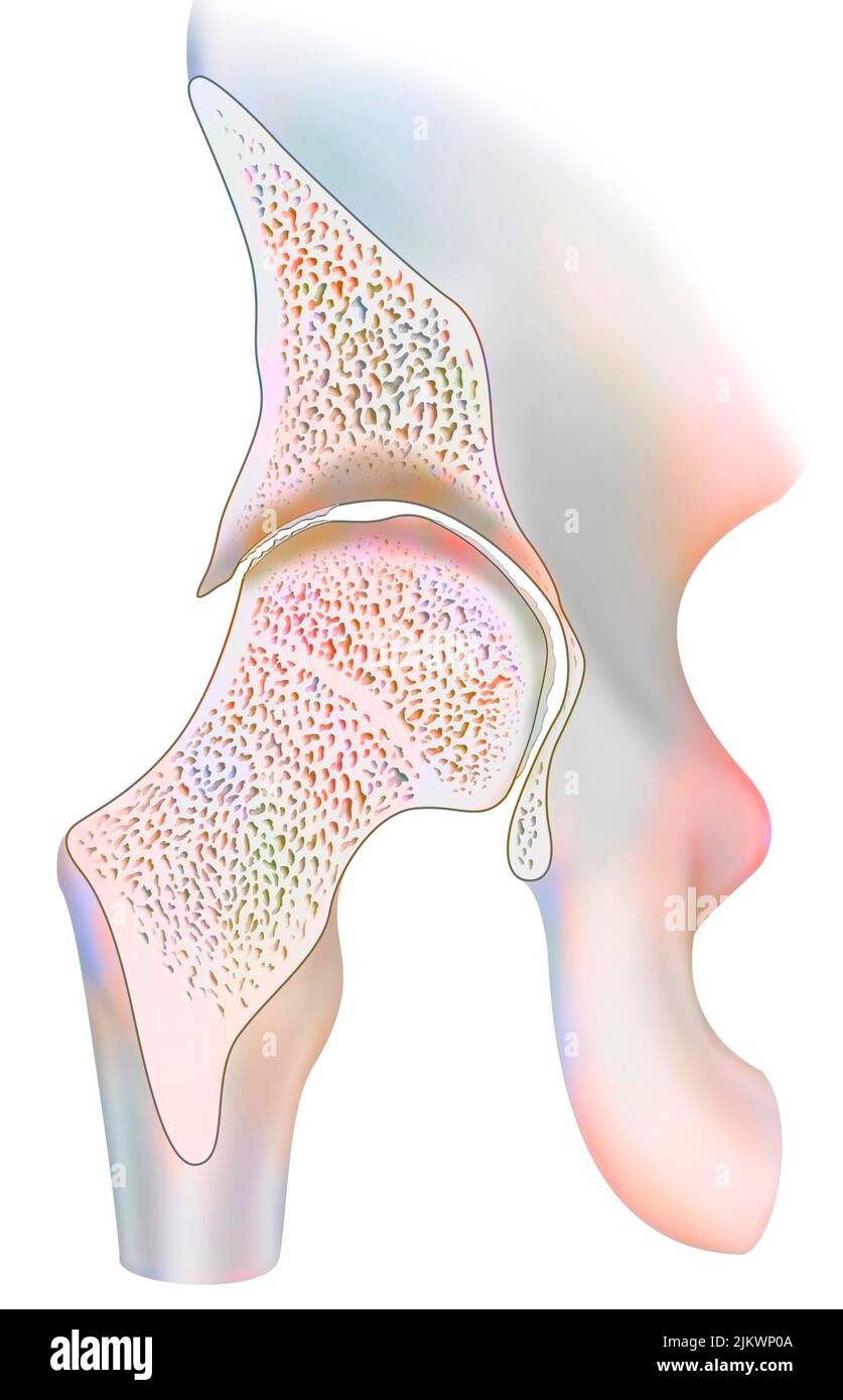 Knöchel durch hämophile Arthropathie im frontalen Schnitt betroffen. Stockfoto