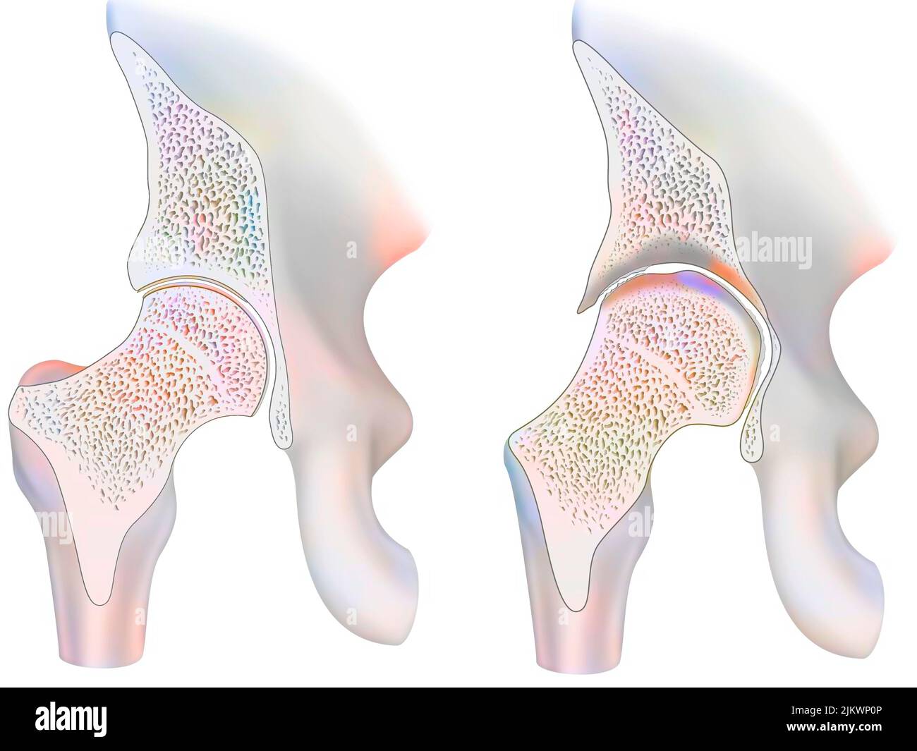 Gesunder Knöchel und Knöchel mit hämophiler Arthropathie im Frontalschnitt. Stockfoto