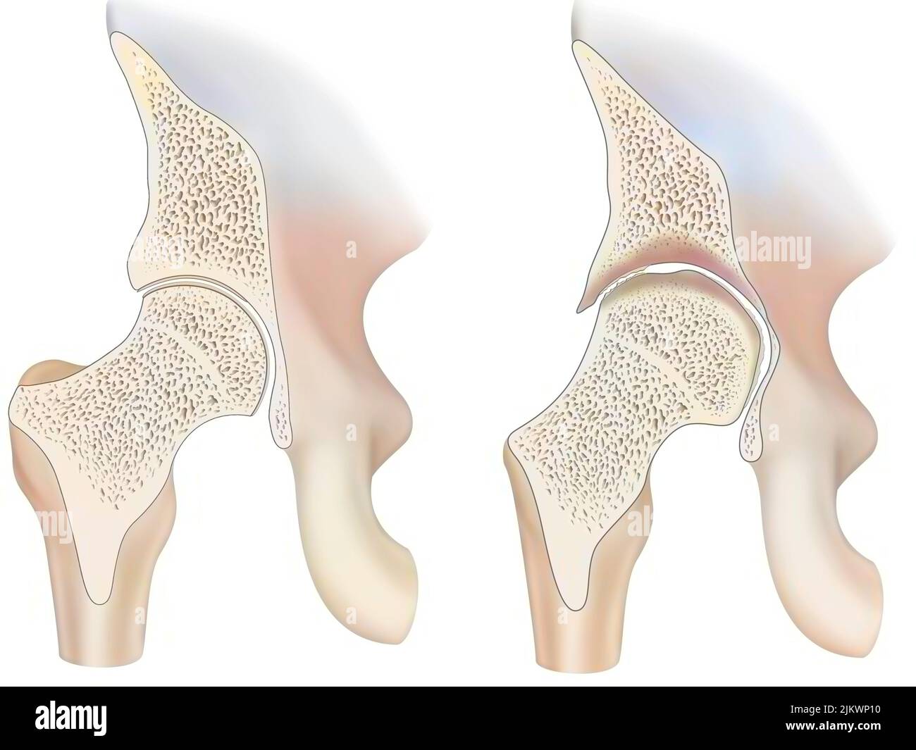 Gesunder Knöchel und Knöchel mit hämophiler Arthropathie im Frontalschnitt. Stockfoto