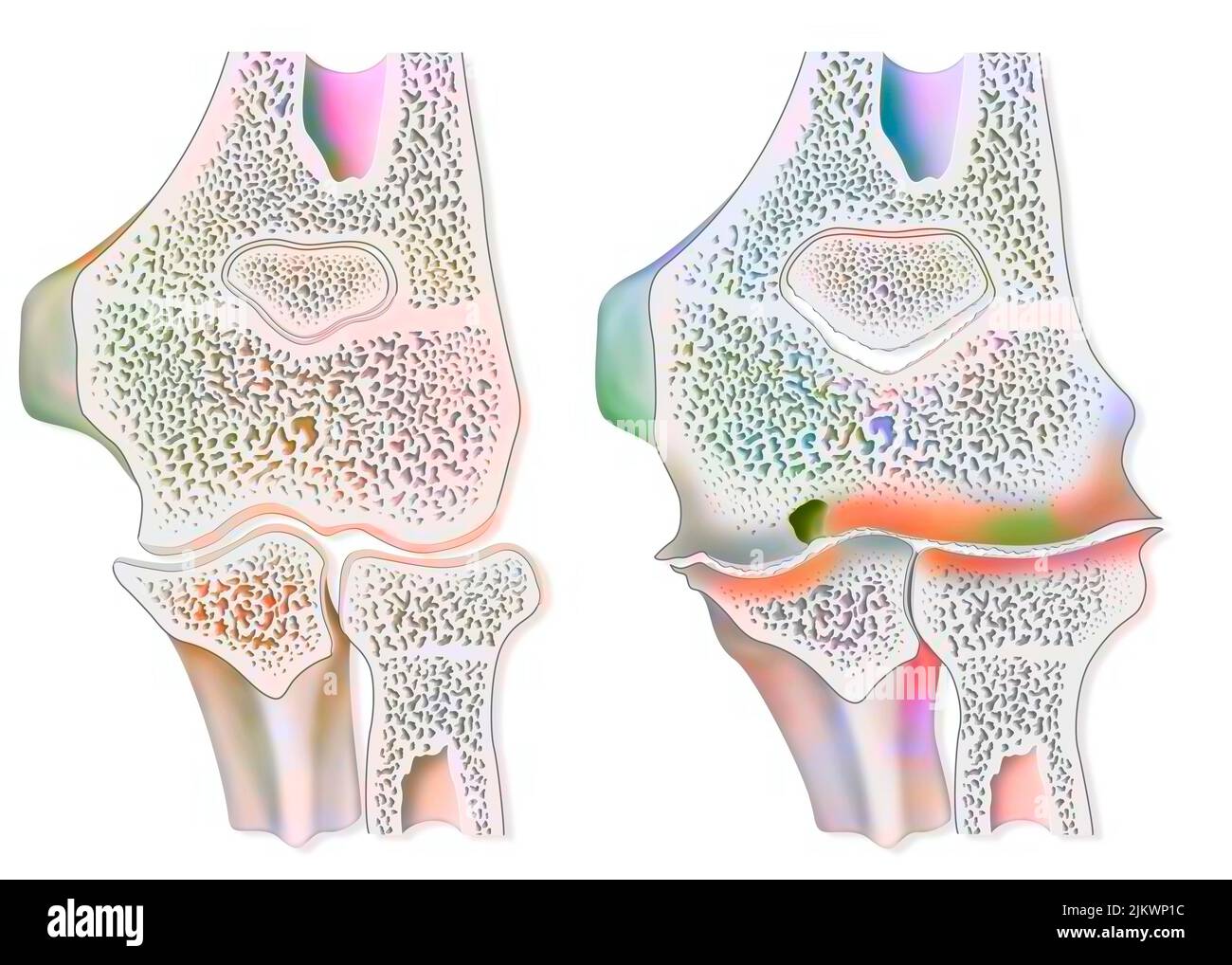 Vergleich zwischen einem gesunden Ellenbogen und einer hämophilen Arthropathie (Hämarthrose). Stockfoto