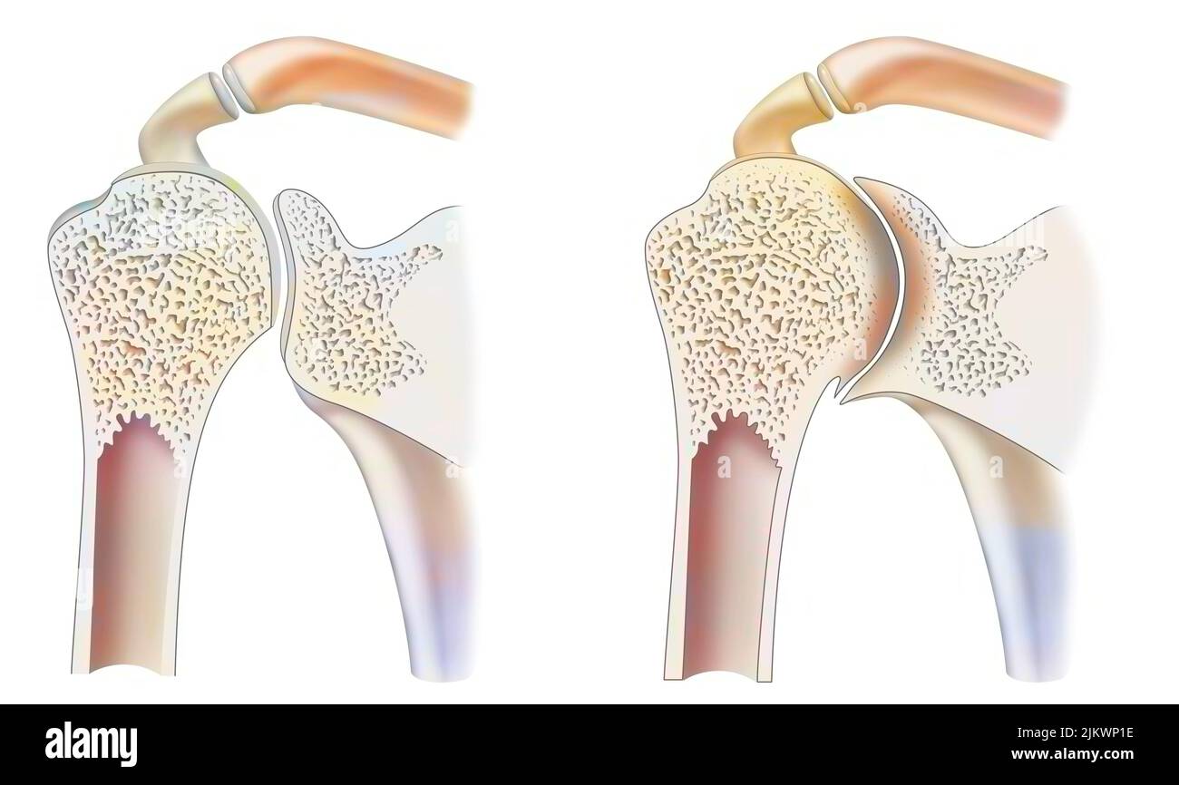Gesunder Knöchel mit hämophiler Arthropathie im Frontalschnitt. Stockfoto