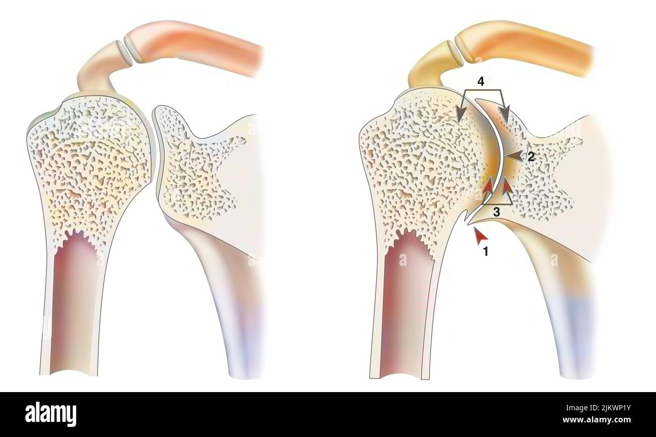 Gesunder Knöchel mit hämophiler Arthropathie im Frontalschnitt. Stockfoto
