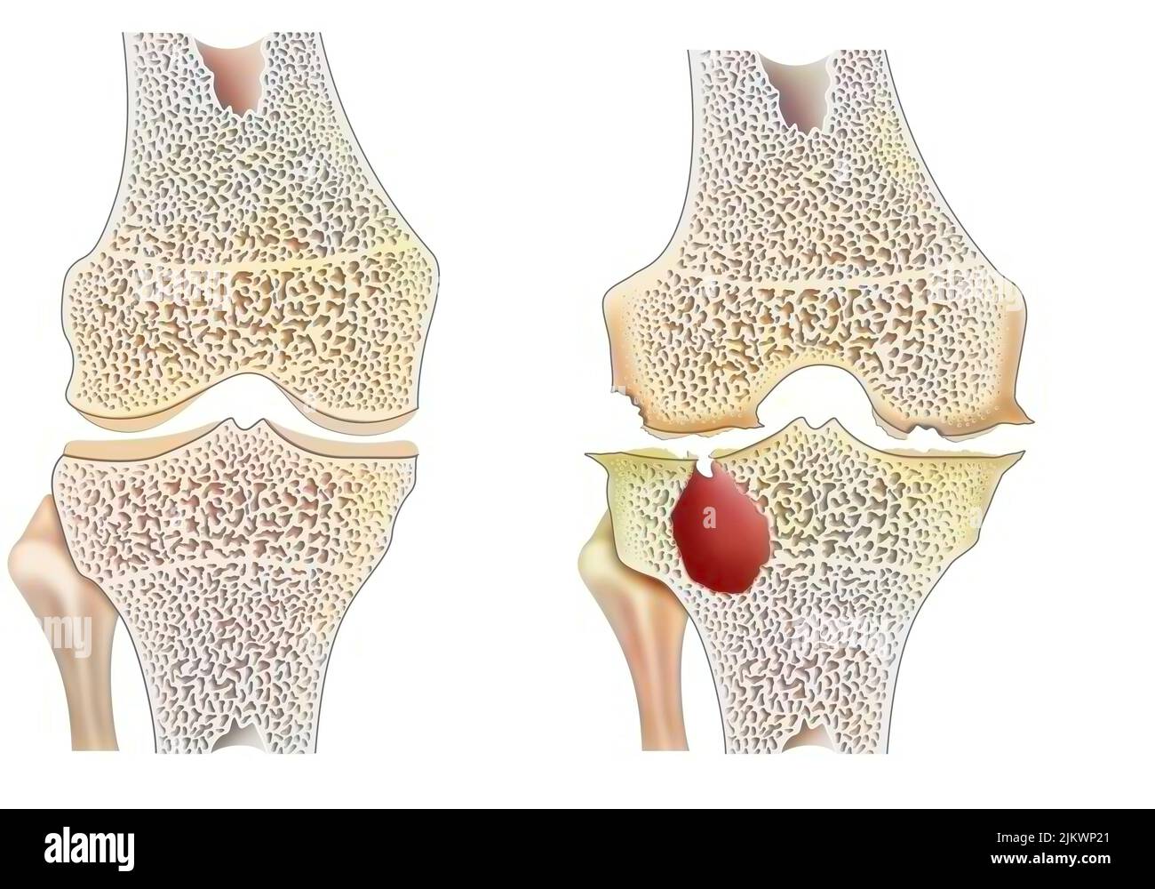 Gesundes Knie mit hämophiler Arthropathie mit marginaler Gelenkerosion. Stockfoto