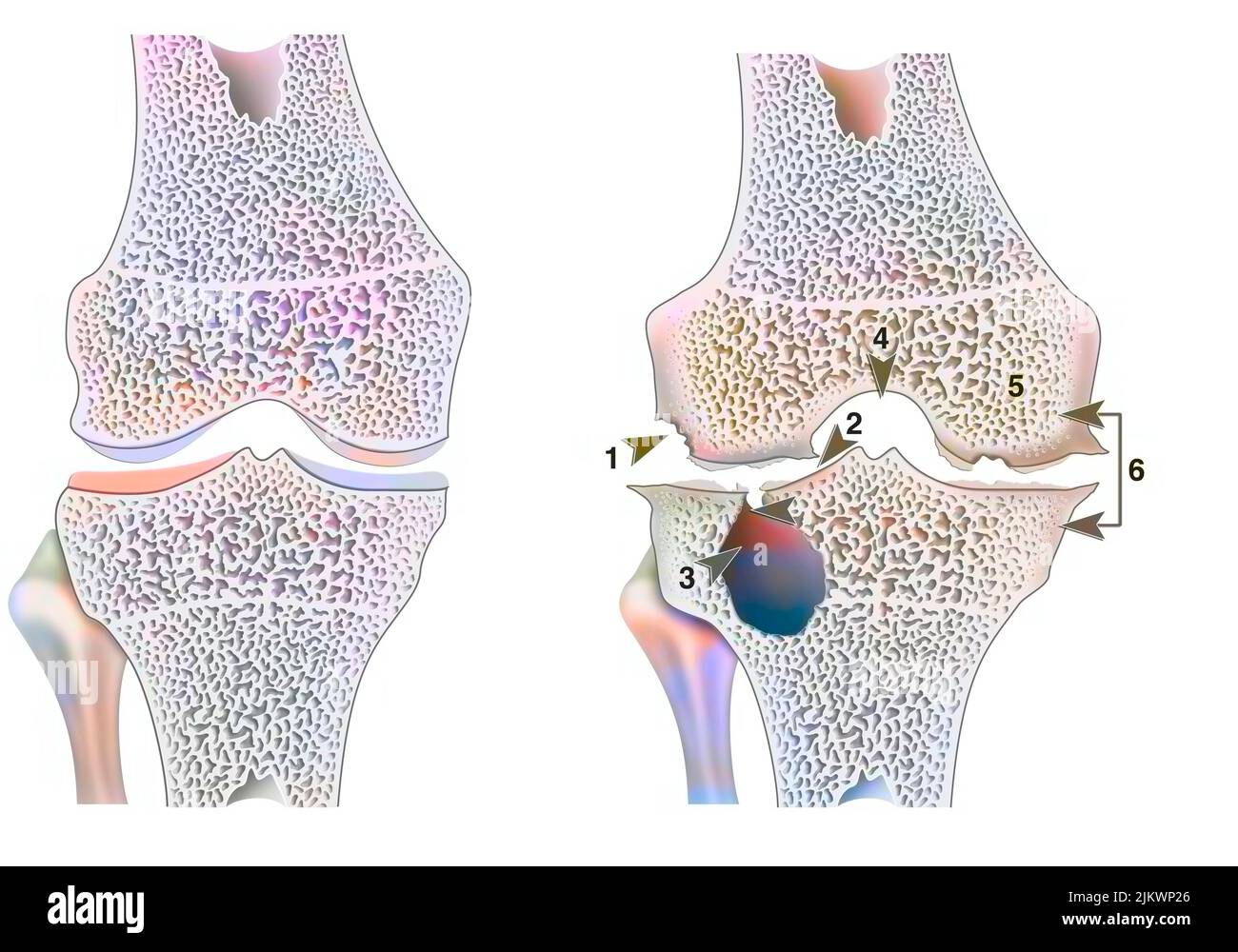 Gesundes Knie mit hämophiler Arthropathie im Frontalschnitt. Stockfoto