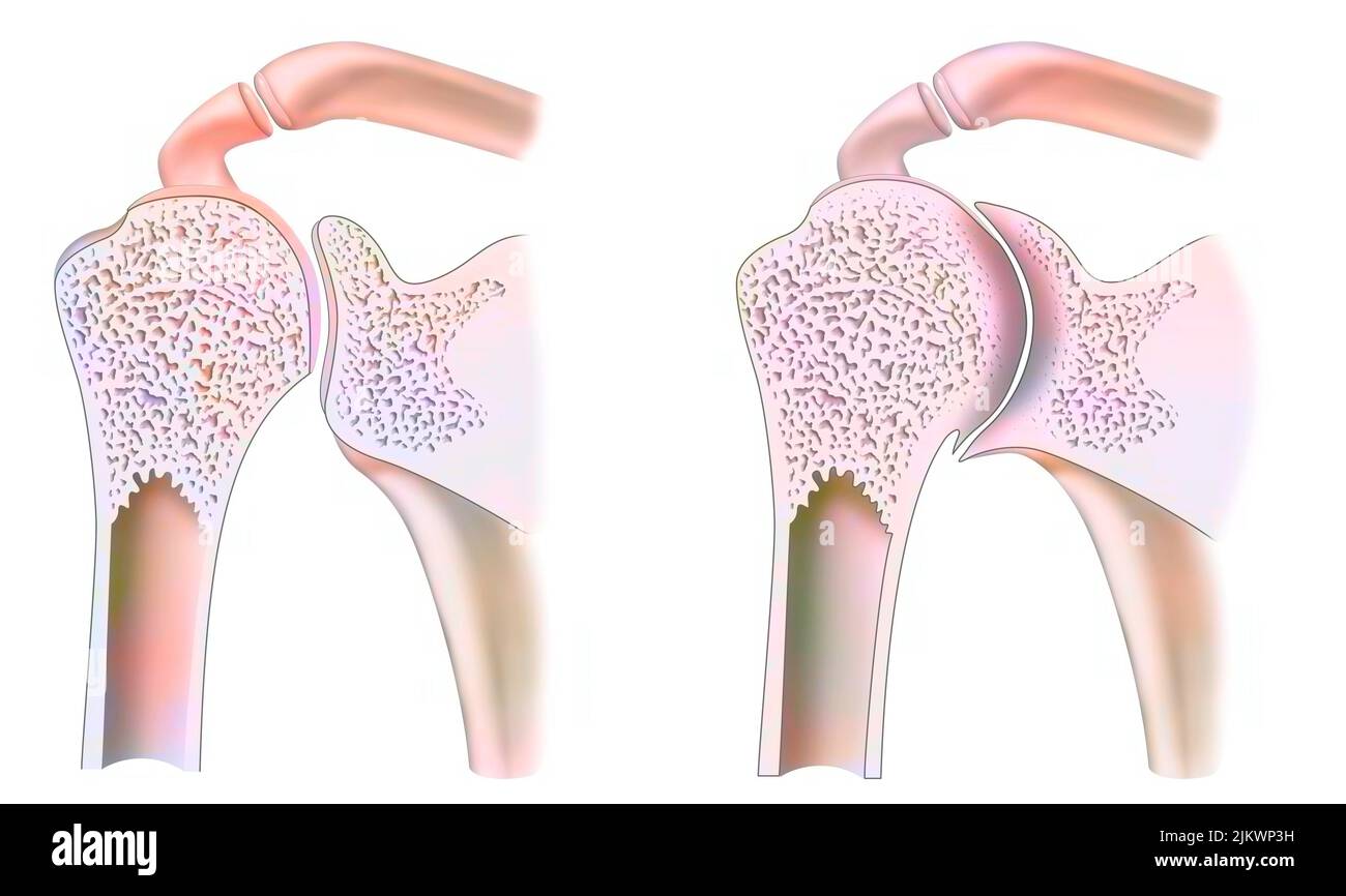 Gesunder Knöchel mit hämophiler Arthropathie im Frontalschnitt. Stockfoto
