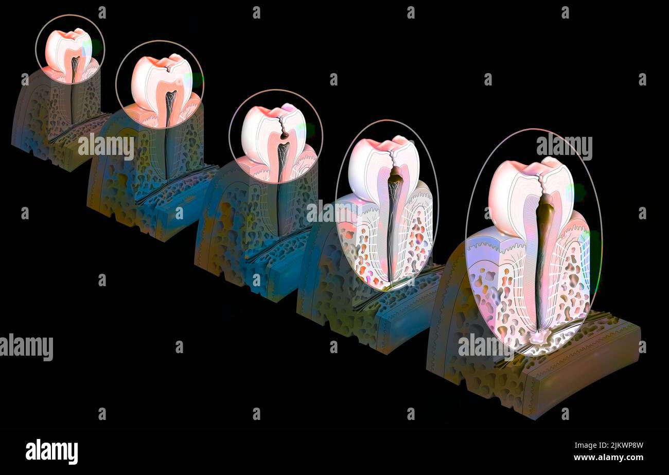Zahn: Bildung und Entwicklung von Zahnkaries. Stockfoto