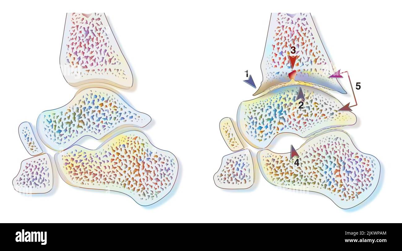 Vergleich zwischen einem gesunden Knöchel und einer hämophilen Arthropathie (Hämarthrose). Stockfoto