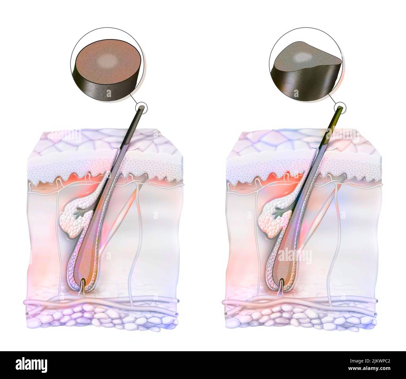 Vergleich zwischen einem gesunden Haar und einem Haar mit unleserlichem Haarsyndrom. Stockfoto