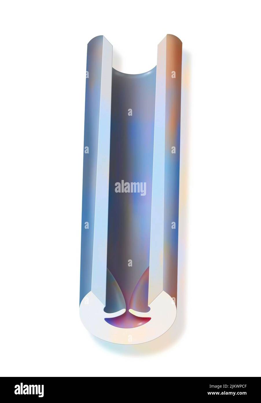 Krampfader: Das innere Lumen der Vene ist unregelmäßig und beginnt sich zu erweitern. Stockfoto