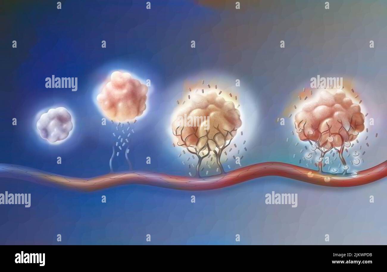 Tumor: Von links nach rechts, Angiogenese und antiangiogene Medikamente. Stockfoto