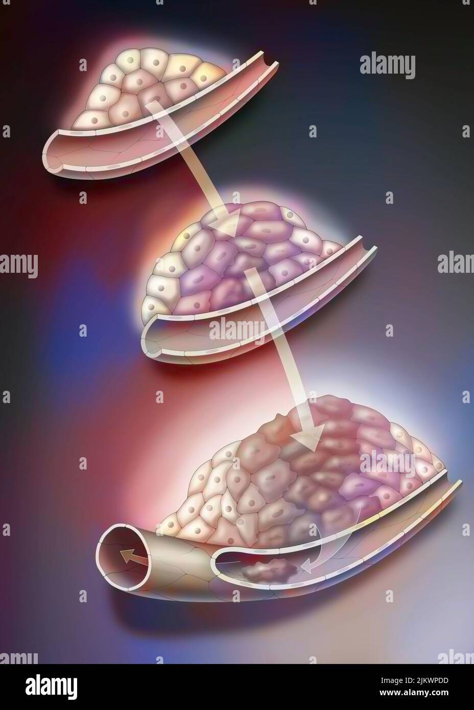 Entwicklung von Krebstumoren: Der Tumor wächst weiter. Stockfoto