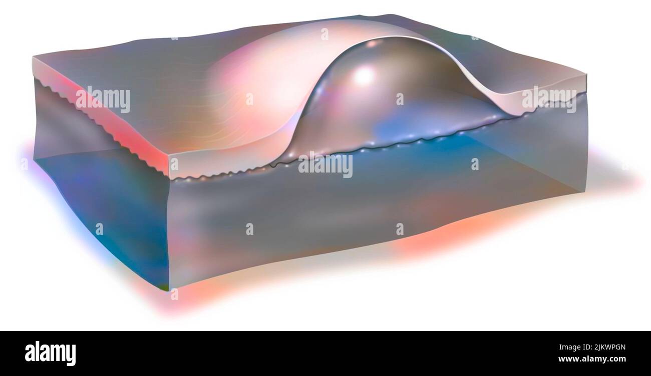 Eine Blase (Blister, Blister) ist eine Blase unter der Haut, die mit Plasma gefüllt ist. Stockfoto