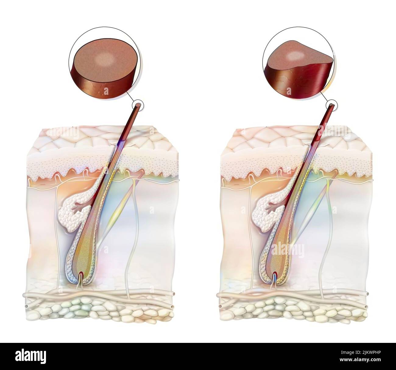 Vergleich zwischen einem gesunden Haar und einem Haar mit unleserlichem Haarsyndrom. Stockfoto