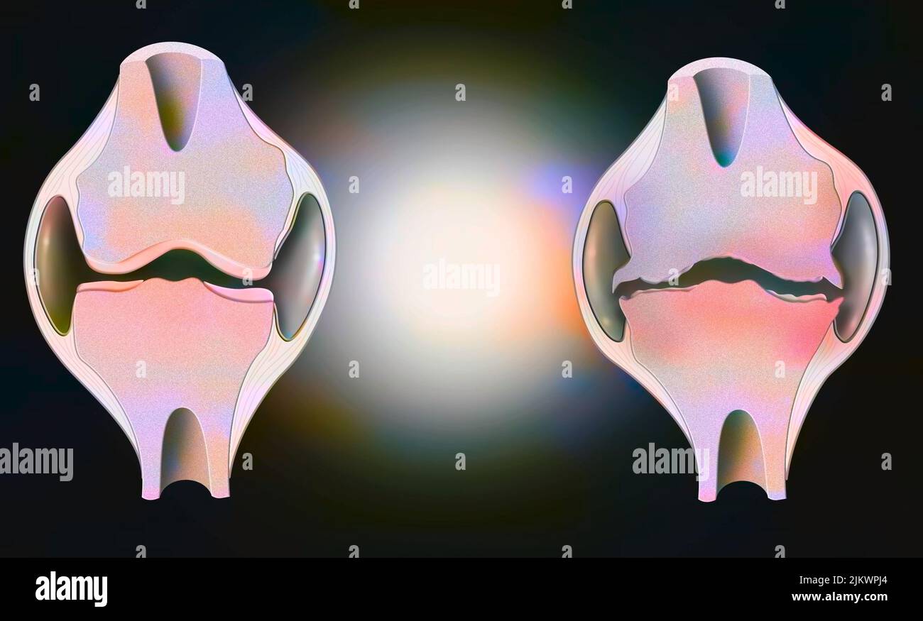 Anatomie des Gelenks eines gesunden Knies links, eines durch Arthrose deformiert rechts. Stockfoto