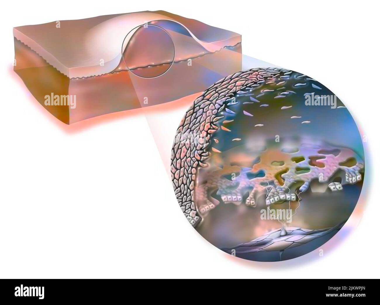 Eine Blase (Blister, Blister) ist eine Blase unter der Haut, die mit Plasma gefüllt ist. Stockfoto