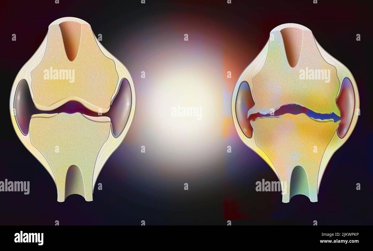 Anatomie des Gelenks eines gesunden Knies links, eines durch Arthrose deformiert rechts. Stockfoto