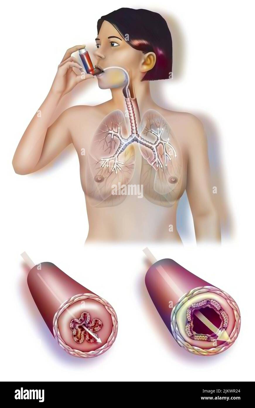 Frau, die während und nach dem Anfall einen Inhalator zur Linderung eines Asthmaanfalls mit einem Bronchialschlauch einnahm. Stockfoto
