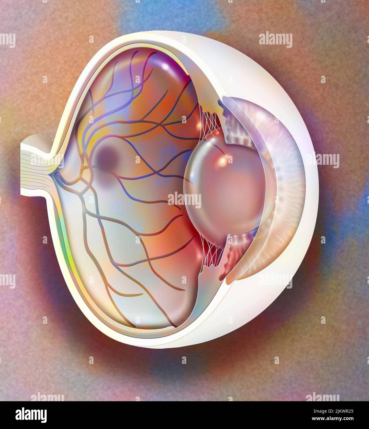 Altersbedingte Makuladegeneration, die die Makula, den zentralen Bereich der Netzhaut, beeinflusst. Stockfoto