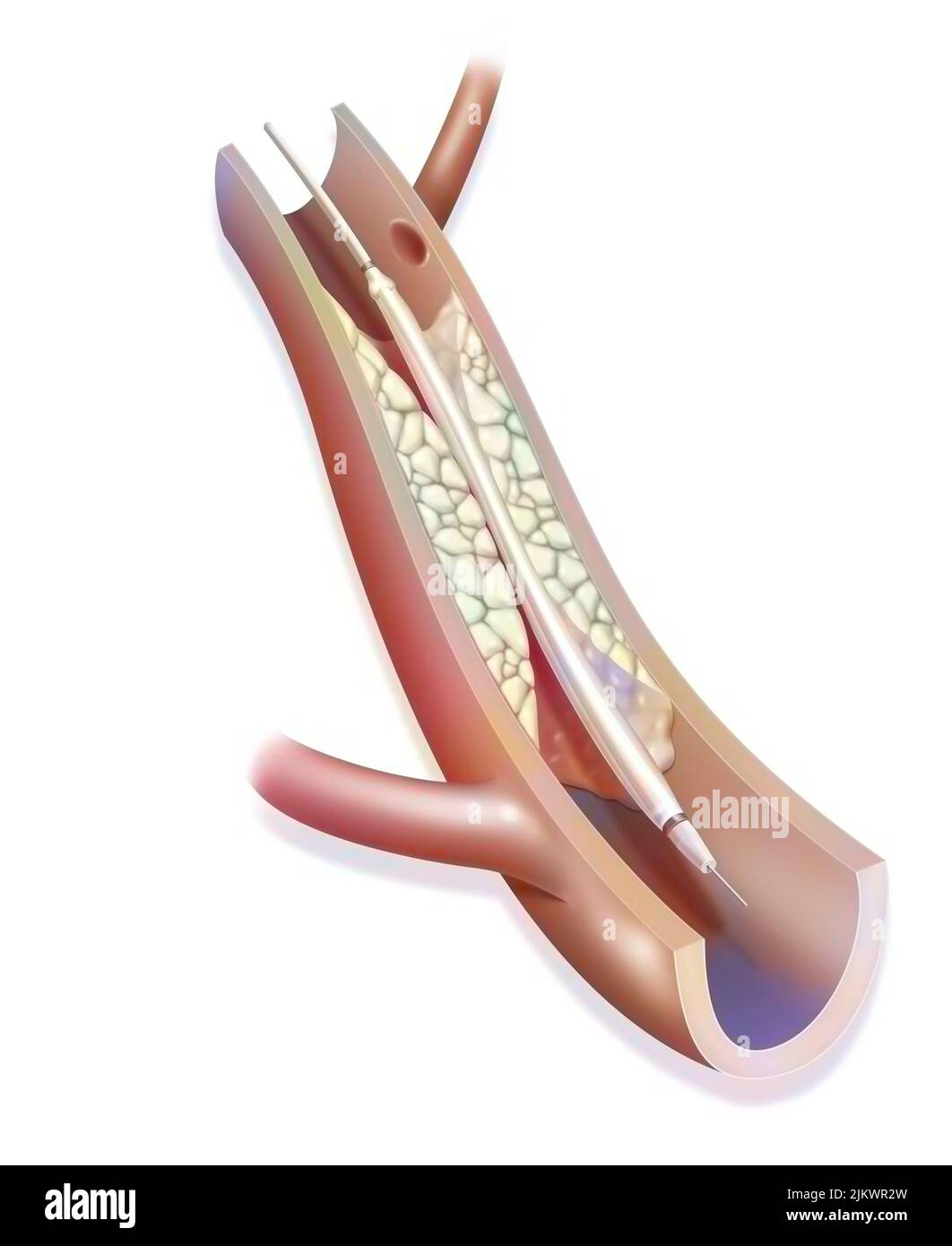 Ballonkatheter-Angioplastie: Schritt 1, Einführung eines mit einem Ballon ausgestatteten Katheters in eine blockierte Arterie. Stockfoto