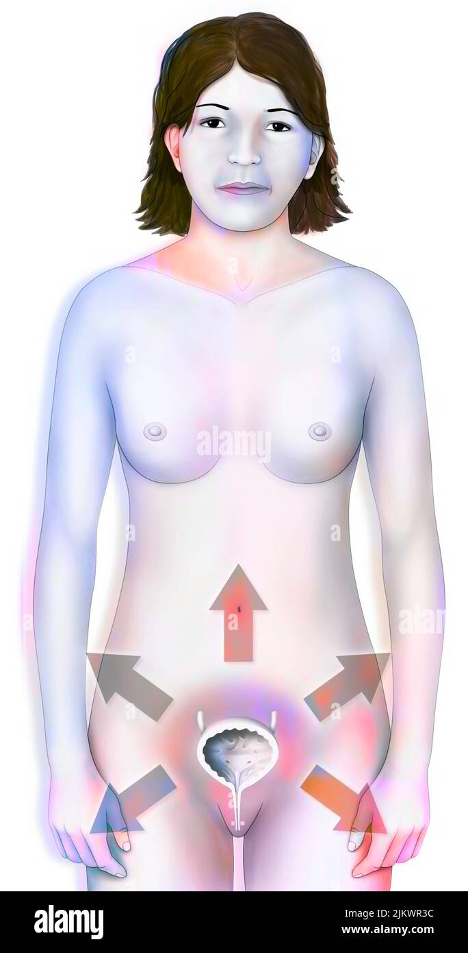 Illustration von Blasenpathologien: Zystitis, Krebs, Lithiasis,. Stockfoto