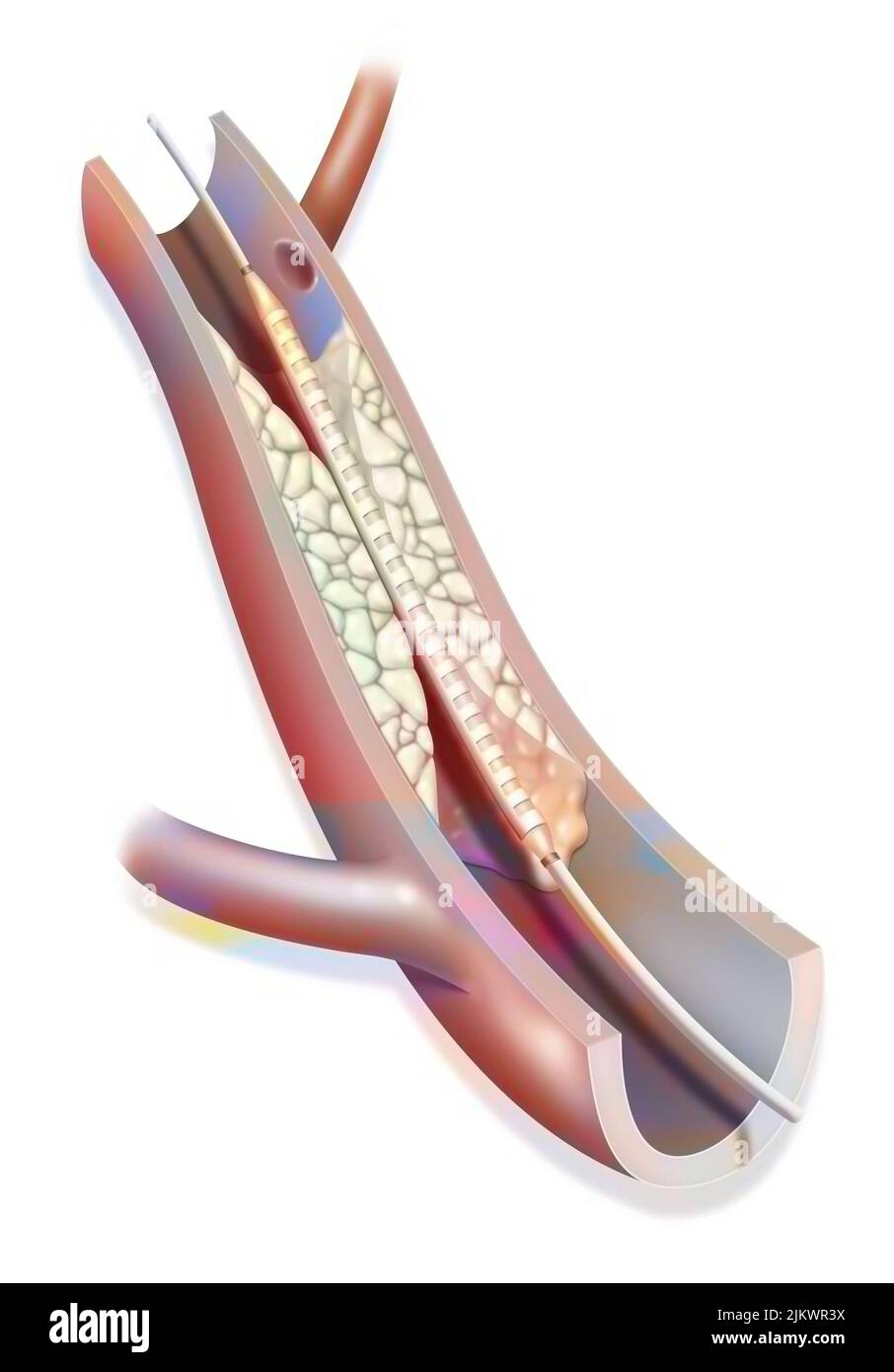 Angioplastie (Stenting) hilft, den Blutfluss zu einer Arterie wiederherzustellen, die durch ein Atherom blockiert wird. Stockfoto