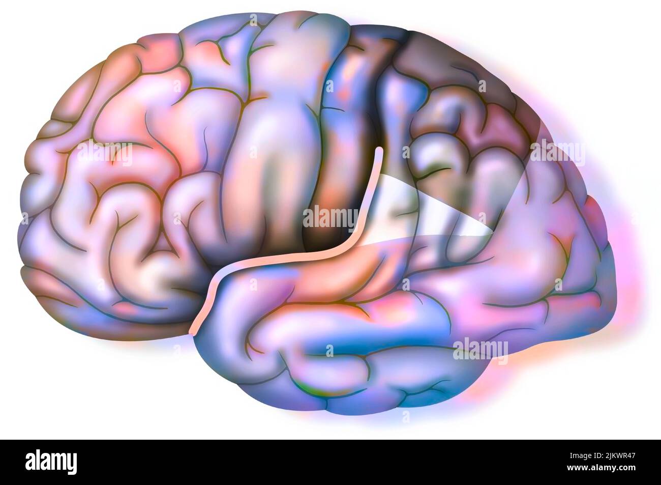 Besonderheit des Gehirns von Einstein, das eine Spaltung von Sylvius darstellt, die nach oben geht. Stockfoto