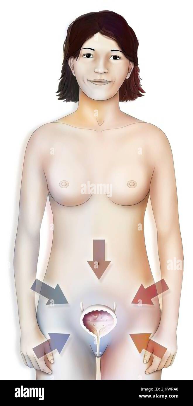 Gesunde oder betroffene Blase (Blasenentzündung, Krebs, Lithiasis..) Bei Frauen. Stockfoto