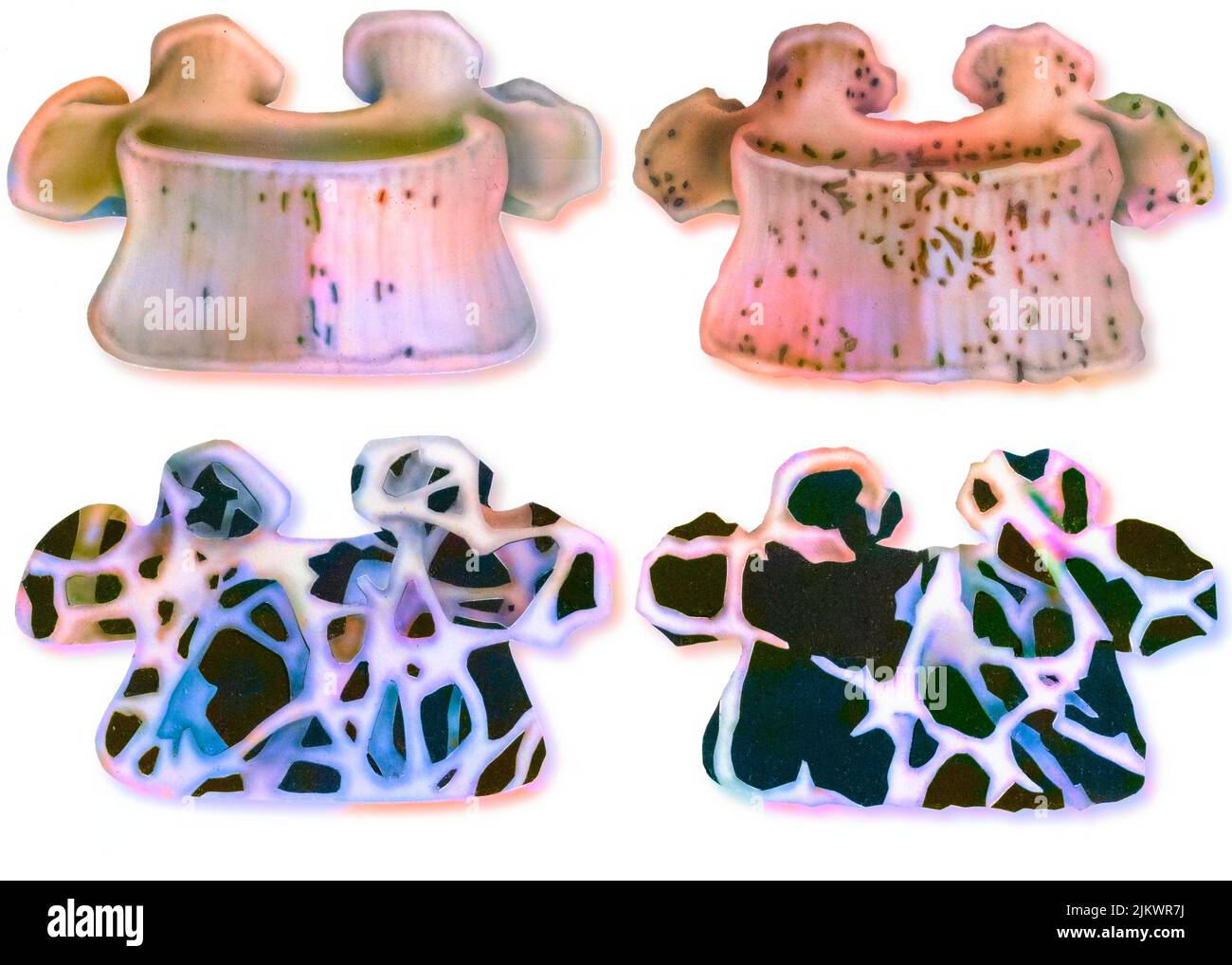 Osteoporose: Vergleich zwischen der Struktur eines jungen Wirbels und der eines alten Wirbels. Stockfoto