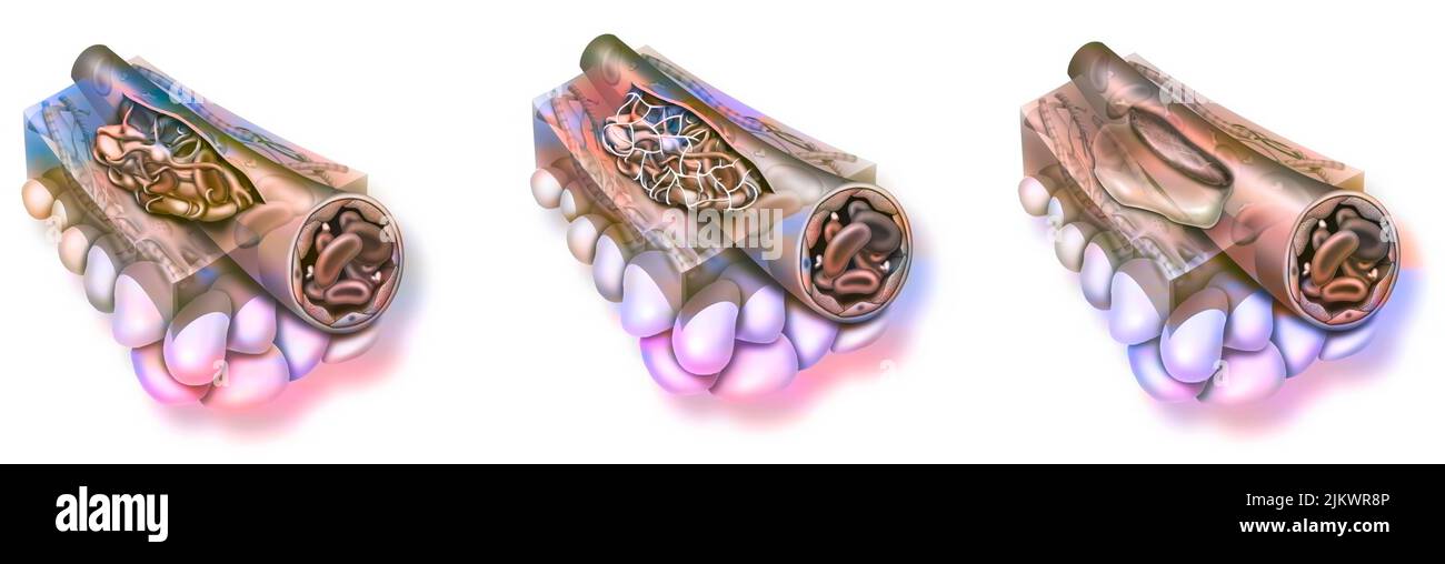 Heilung: konstitution eines Stopfens, Konsolidierung des Thrombozytennagels, Evakuierung des Serums. Stockfoto