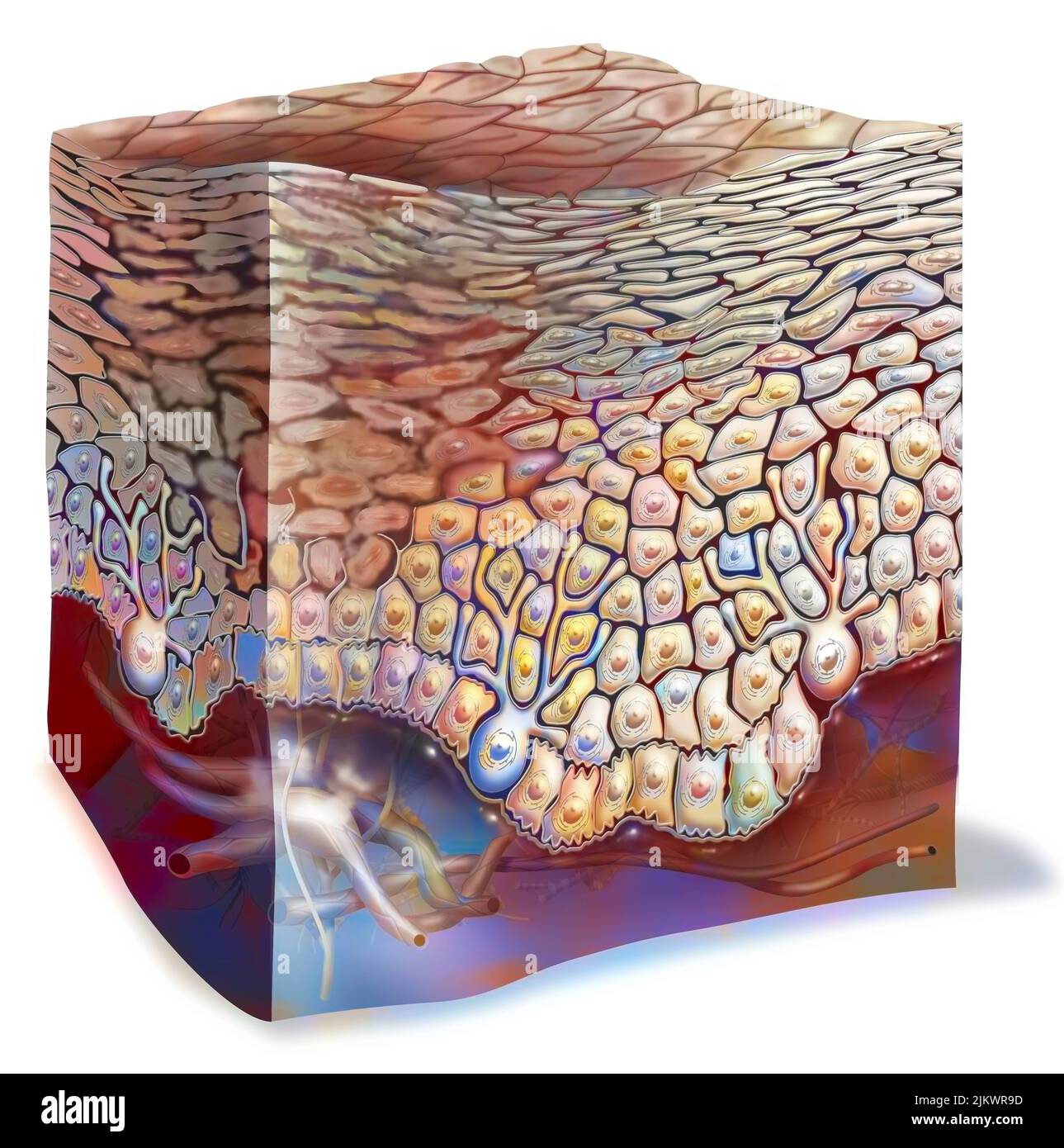 Sonnenbrand ersten Grades: Keratinozyten werden zerstört. Stockfoto
