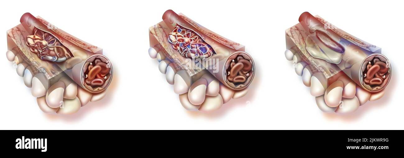Heilung: konstitution eines Stopfens, Konsolidierung des Thrombozytennagels, Evakuierung des Serums. Stockfoto