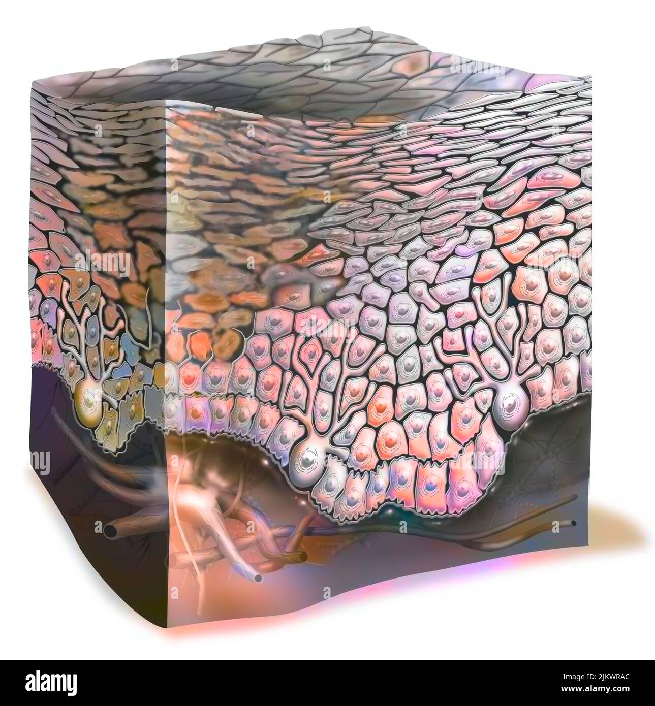 Sonnenbrand ersten Grades: Keratinozyten werden zerstört. Stockfoto