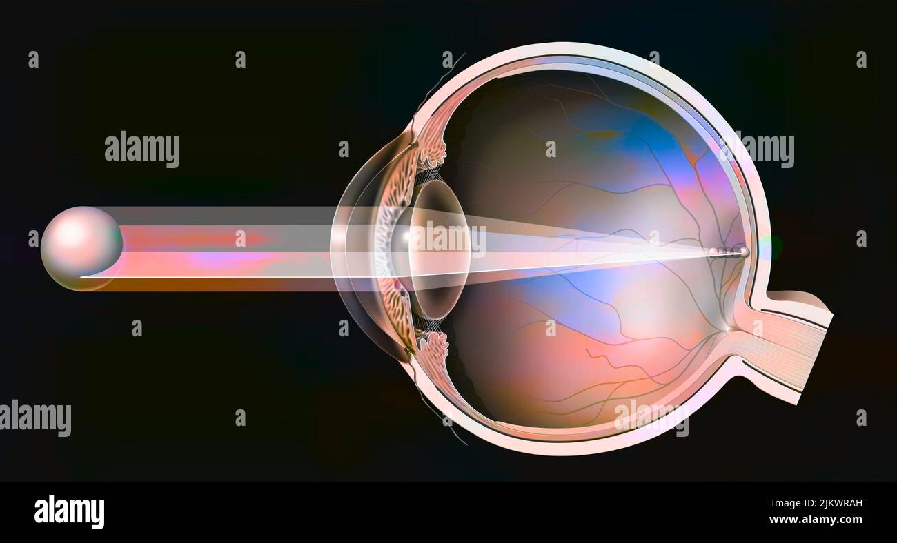 Astigmatisches Auge (eiförmige und nicht-kugelförmige Hornhaut) mit der Bildung eines Bildes. Stockfoto