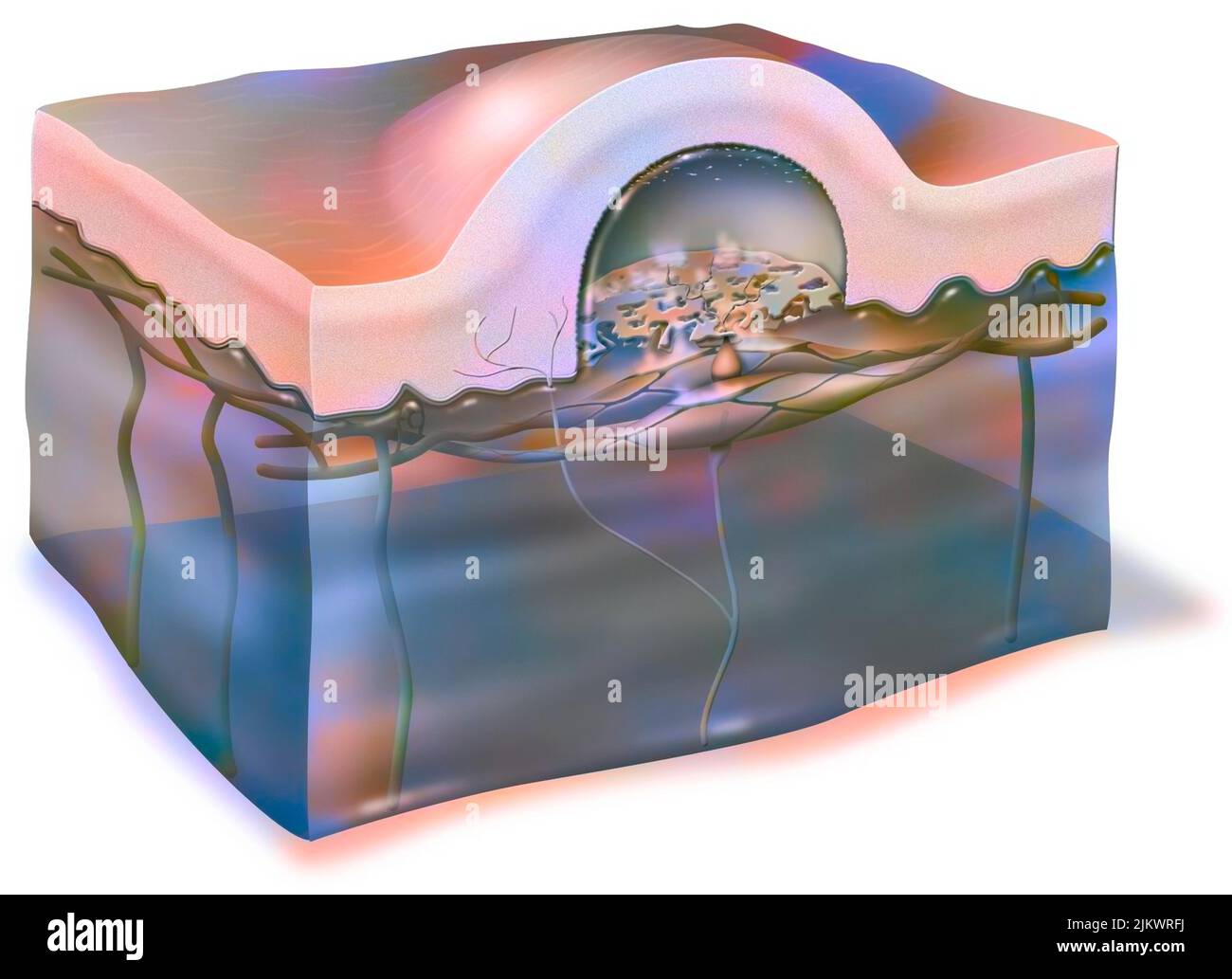 Phlycten (Blister, Blister): Blase unter der Haut gefüllt mit Plasma. Stockfoto