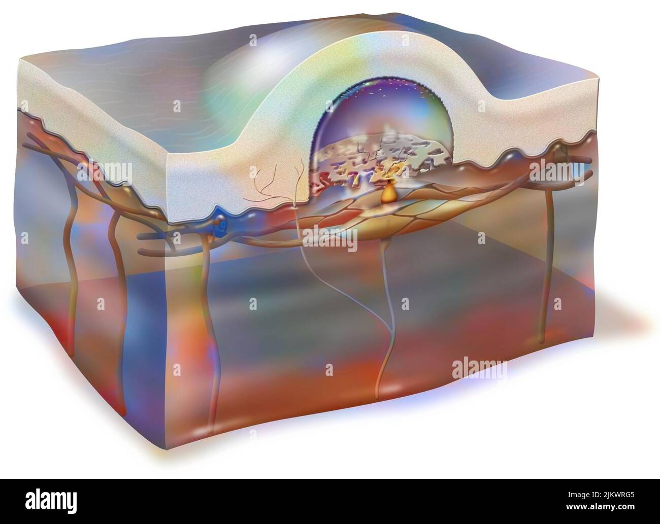 Phlycten (Blister, Blister): Blase unter der Haut gefüllt mit Plasma. Stockfoto