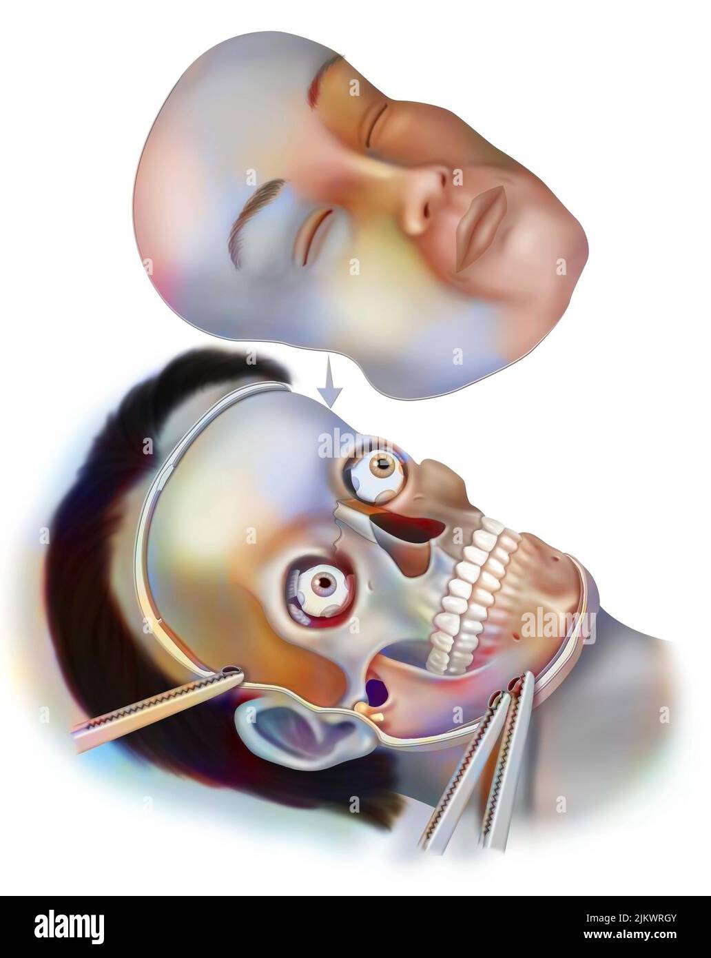 Transplantation eines neuen Gesichts auf das Gesichtsskelett eines Patienten. Stockfoto