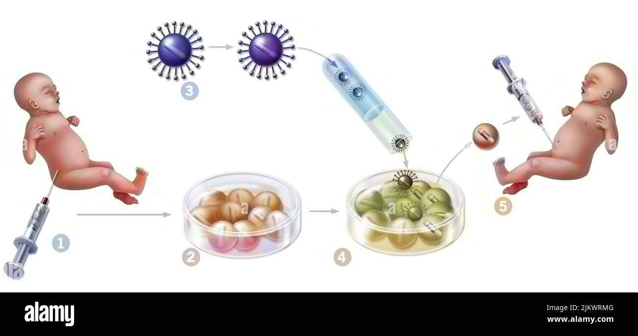 Gentherapie: Einführung von Retroviren, um mutierte Rückenmarkszellen eines Neugeborenen zu modifizieren. Stockfoto