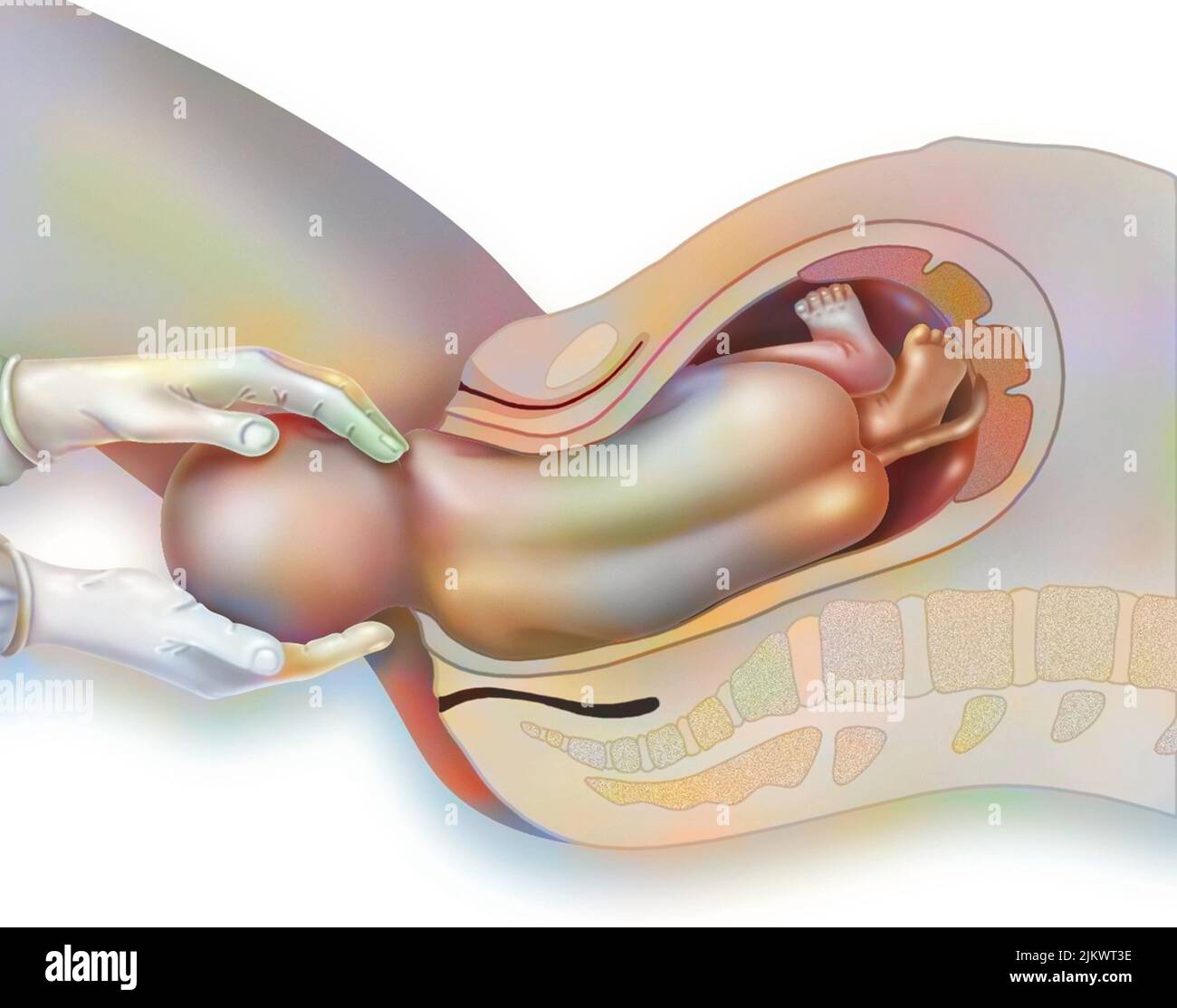 Geburt, Schritt 3: Freigabe der oberen Schulter durch die Hebamme. Stockfoto