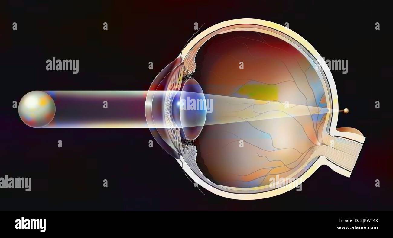 Presbyopisches Auge mit der Bildung des Bildes hinter der Netzhaut. Stockfoto