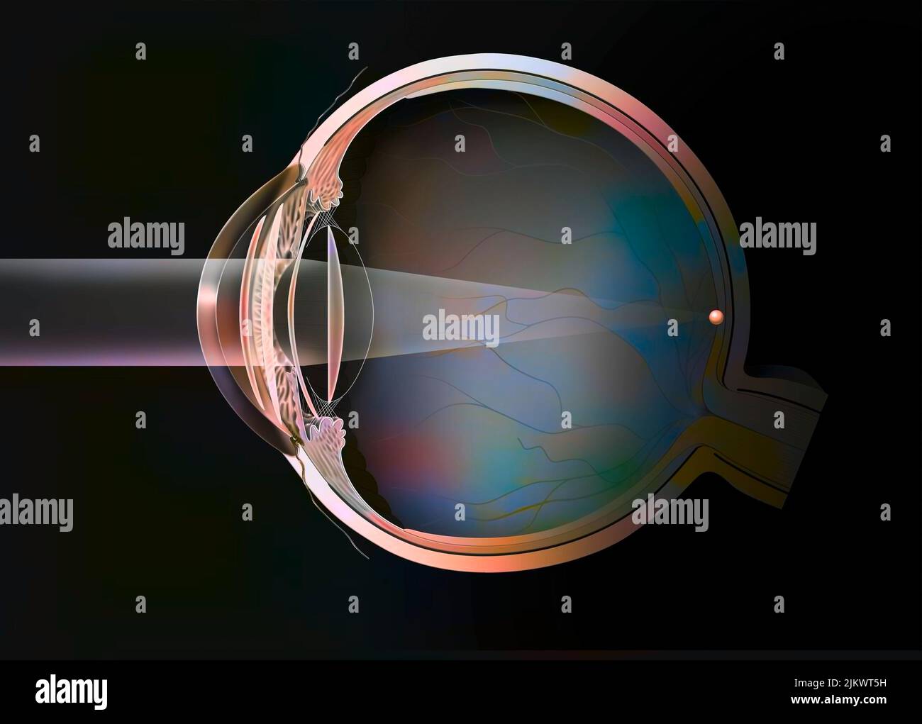 Verschiedene intraokulare Implantate: Phakisches Implantat (vordere, hintere Kammer), Iris, aphakisches Implantat. Stockfoto