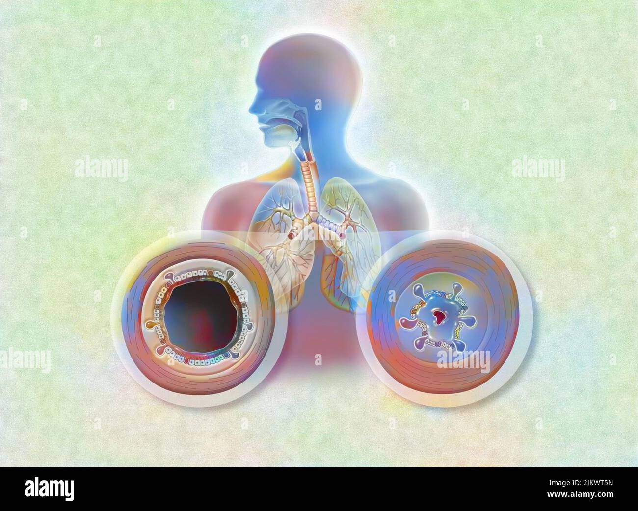 Vergleich zwischen gesunden Bronchien und Bronchitis (akute Bronchitis). Stockfoto