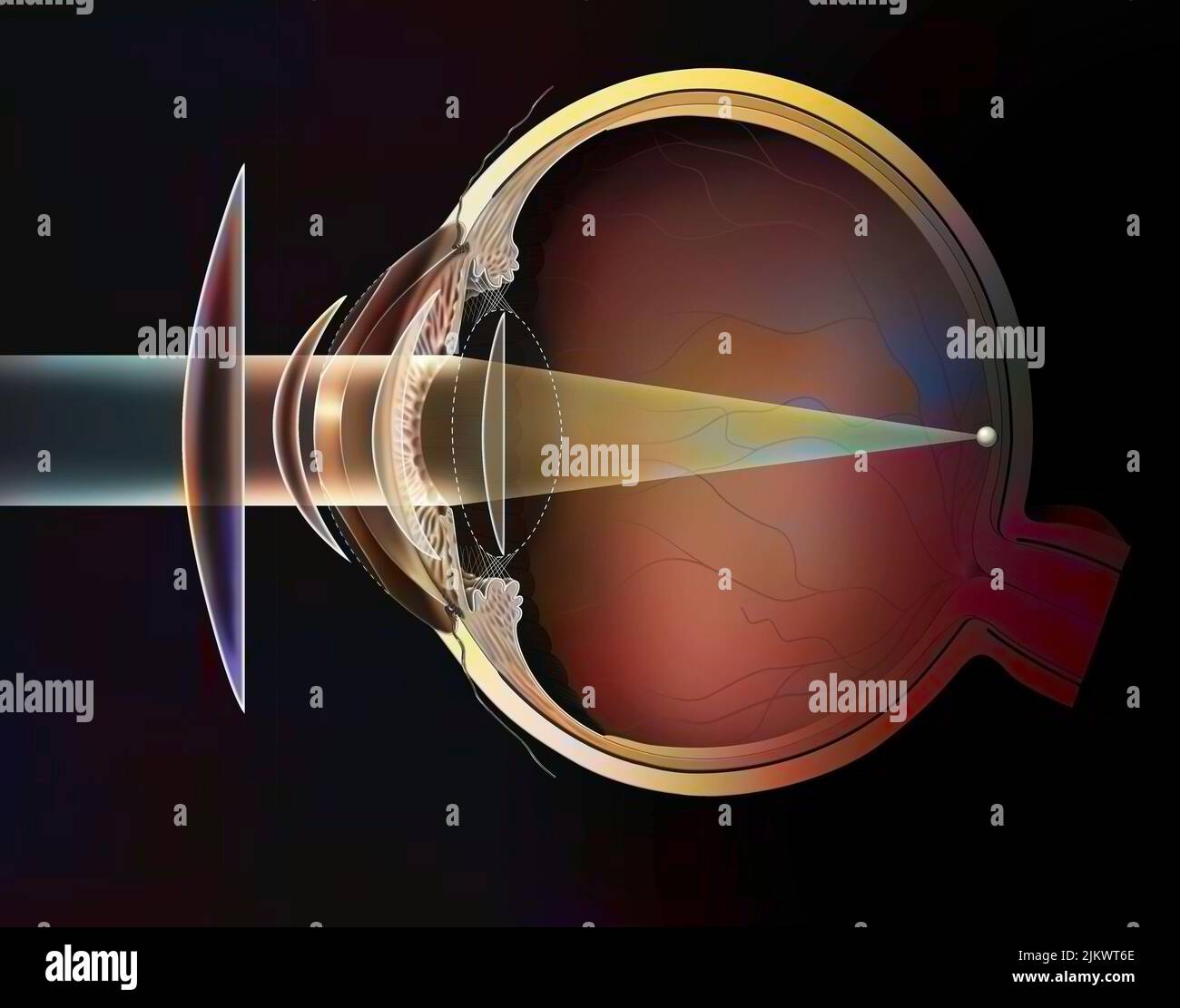 Verschiedene mögliche Korrekturen des hyperopischen Auges: Brillenlinsen - äusserliche Linsen. Stockfoto