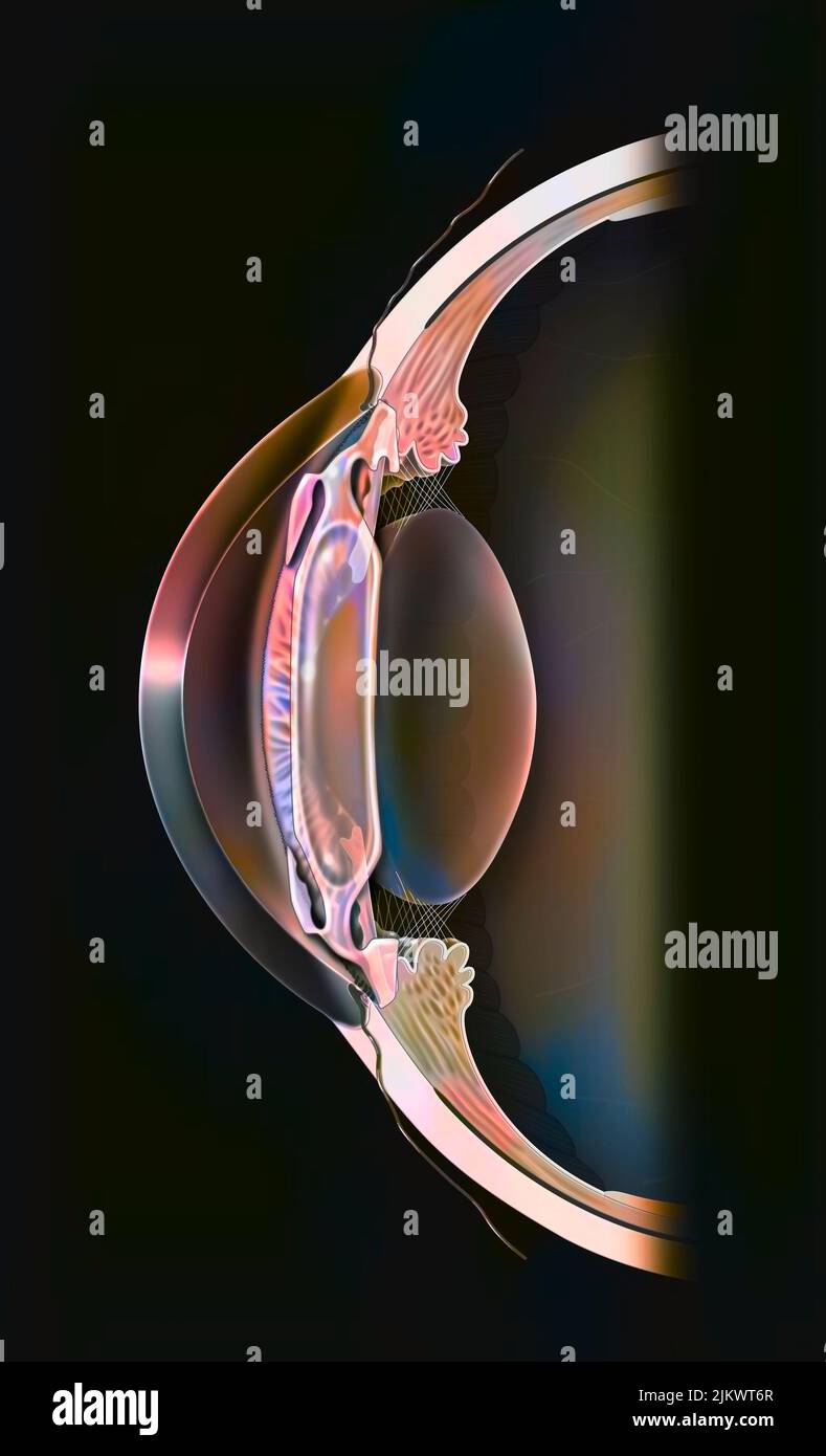 Auge, intraokulares Implantat in der Vorderkammer zwischen Hornhaut und Iris. Stockfoto